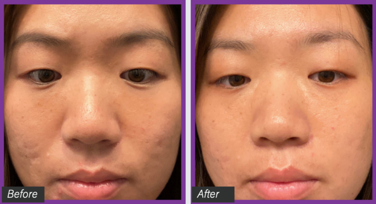 Ultraclear Laser Treatment Nyc Dagan Md Facial Plastic Surgery