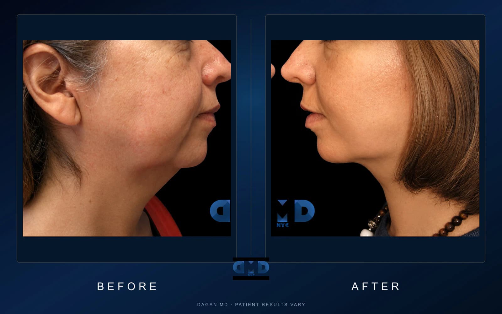Facelift · Featured profile — Dagan MD patient results Facelift · Featured profile, side-by-side profile patient photographs demonstrating documented lower-face, jawline and neck-contour changes. Individual results vary.