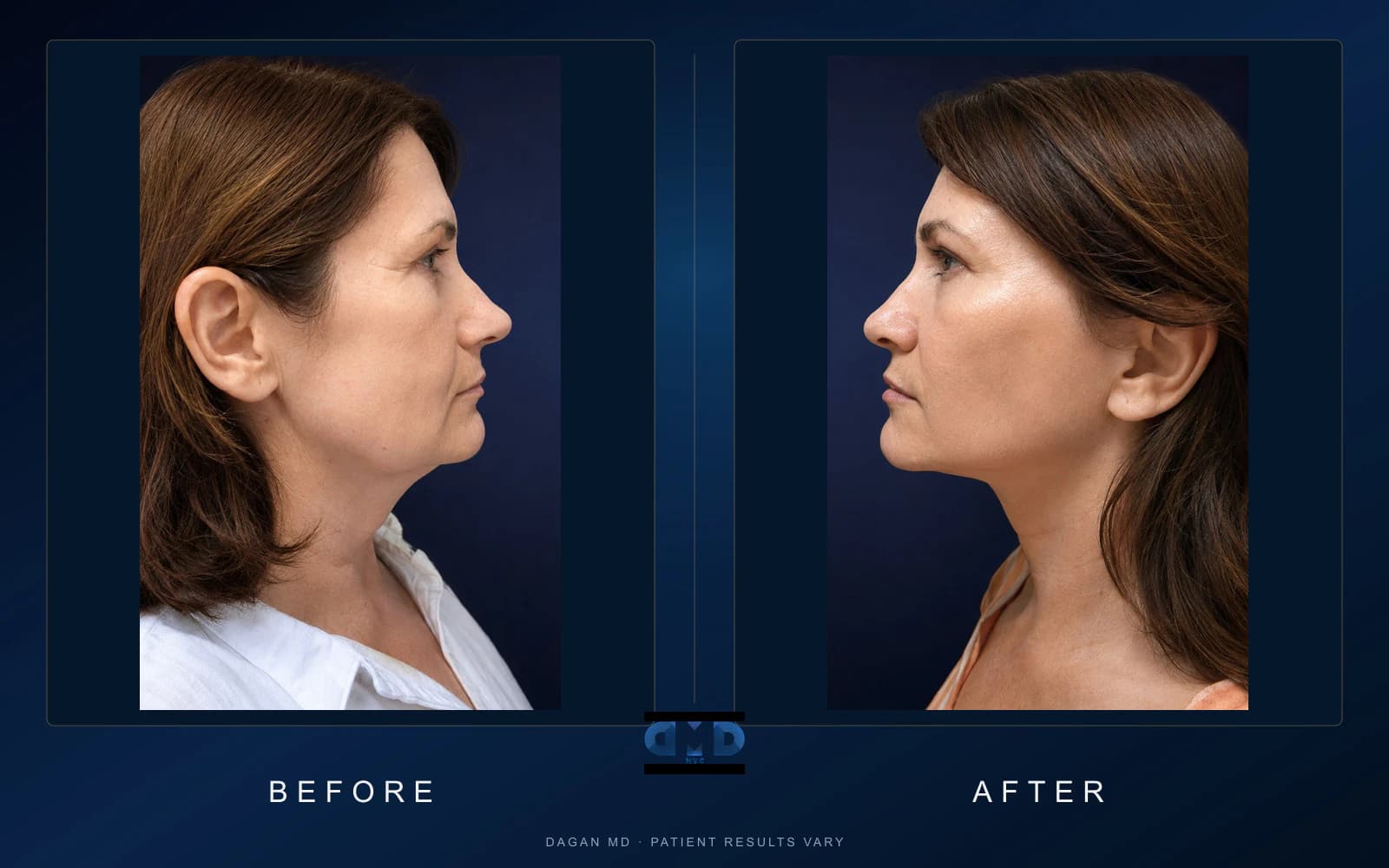 Facelift · Profile — Dagan MD patient results Centered, side-by-side full-color facelift before-and-after profile photographs on a navy Dagan MD background