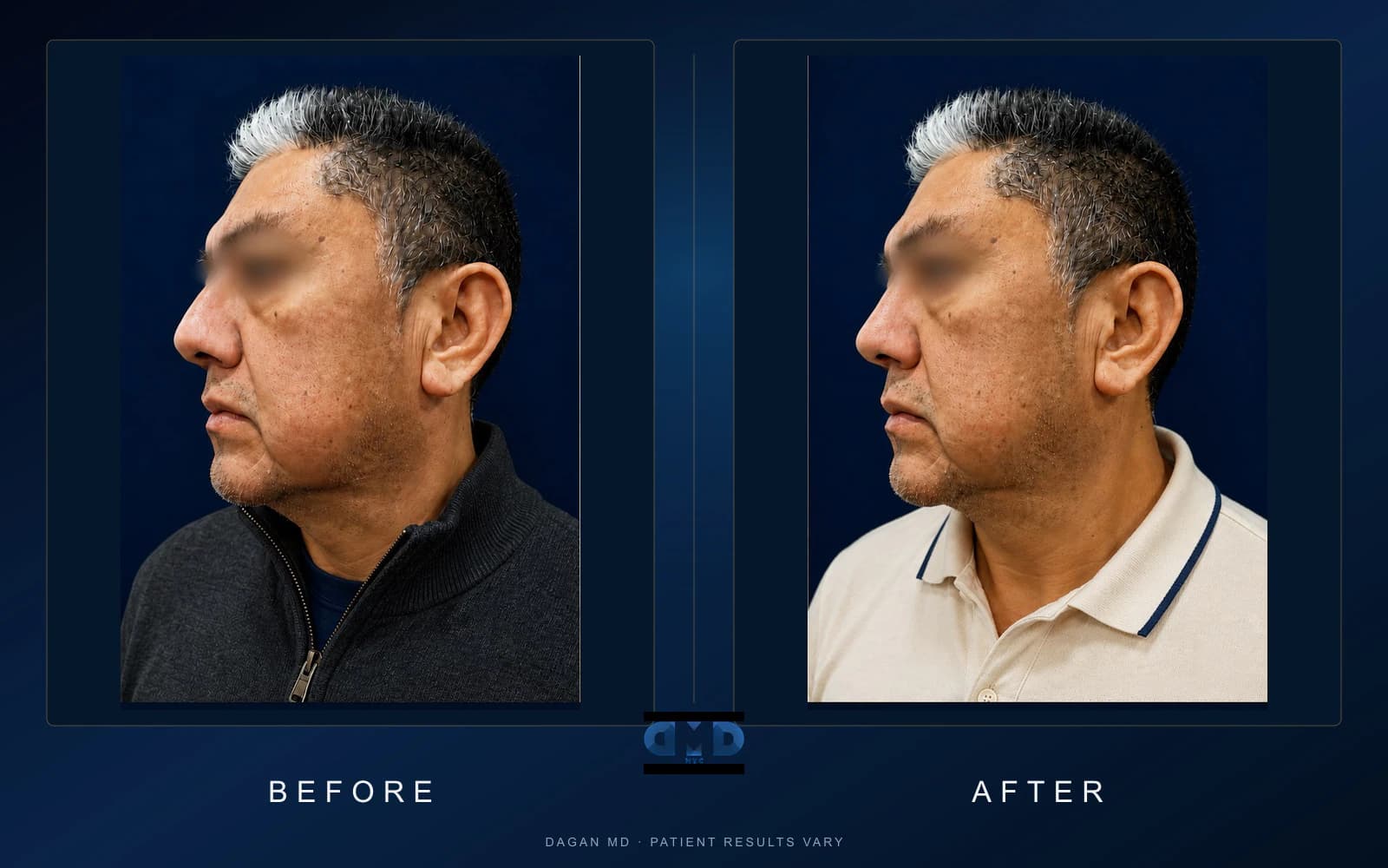Jawline Edit in New York City — Dagan MD Neck lift case 01 before-and-after photographs illustrating jaw-to-neck contour refinement; individual results vary