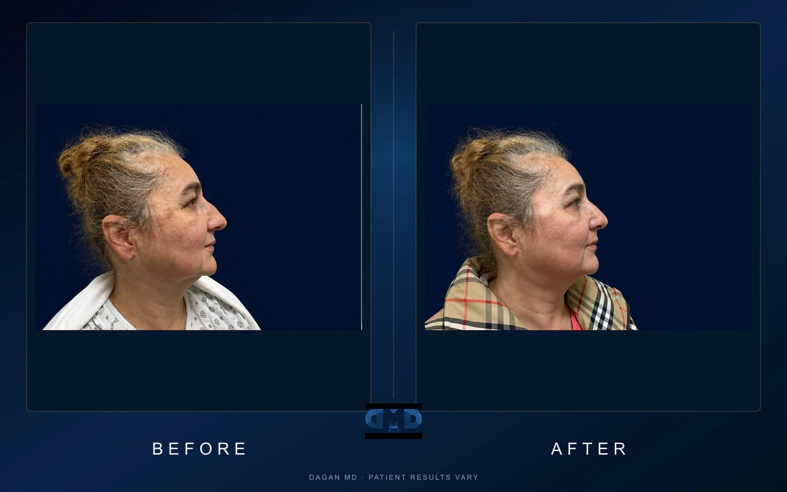 Neck lift · Contour — Dagan MD patient results Neck lift · Contour, side-by-side profile patient photographs demonstrating documented lower-face and cervical-contour changes. Individual results vary.
