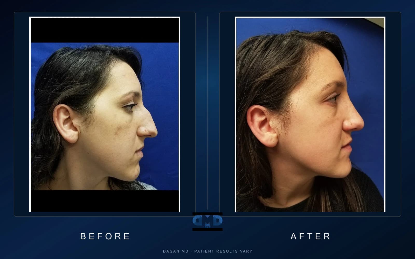 Rhinoplasty · Profile — Dagan MD patient results Rhinoplasty · Profile, side-by-side profile patient photographs demonstrating documented dorsal-line and tip-position changes. Individual results vary.