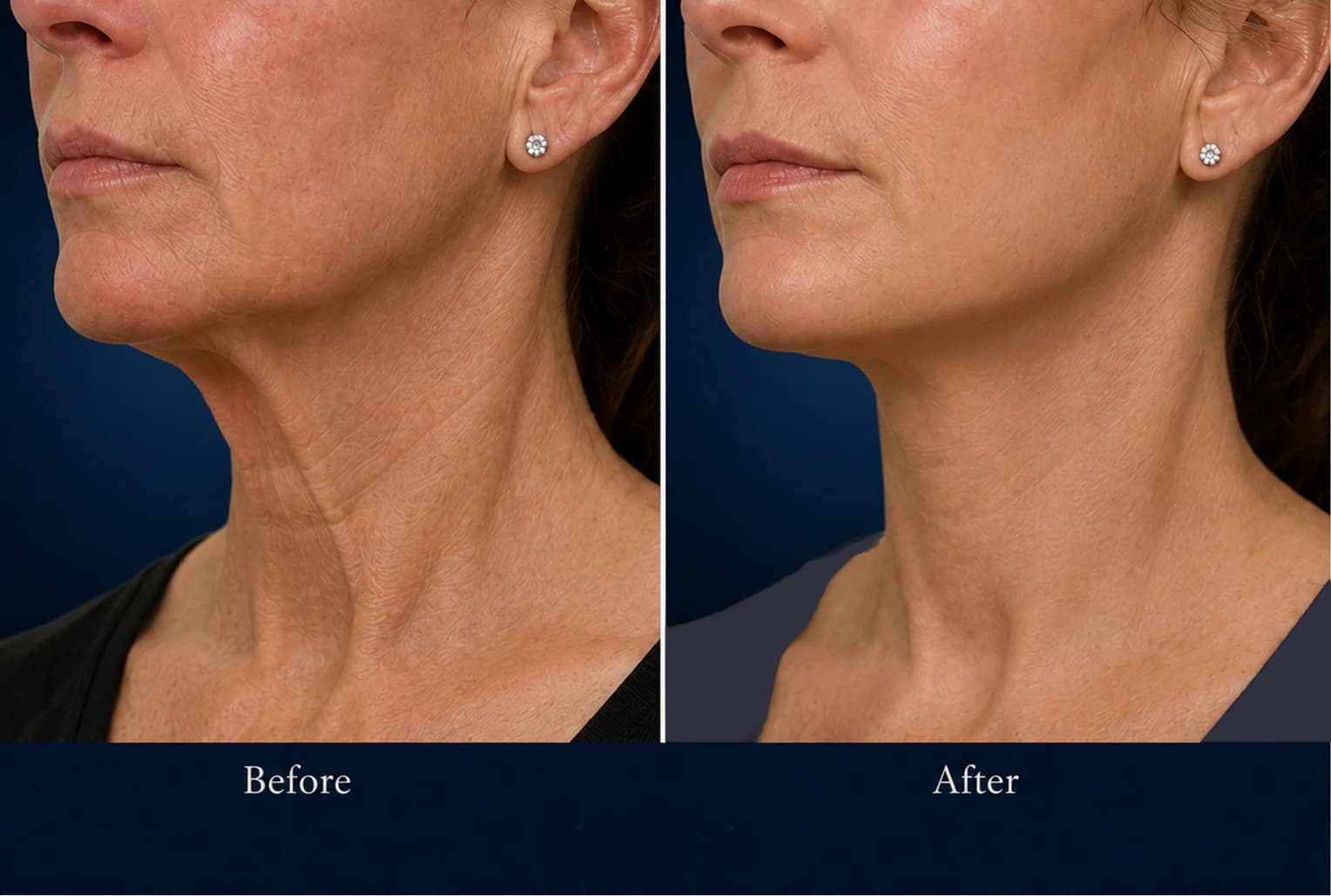 Patient 1 · Neck contour — neck lift before and after in New York City Side-by-side full-color neck lift before-and-after comparison showing the lower face, jawline and neck