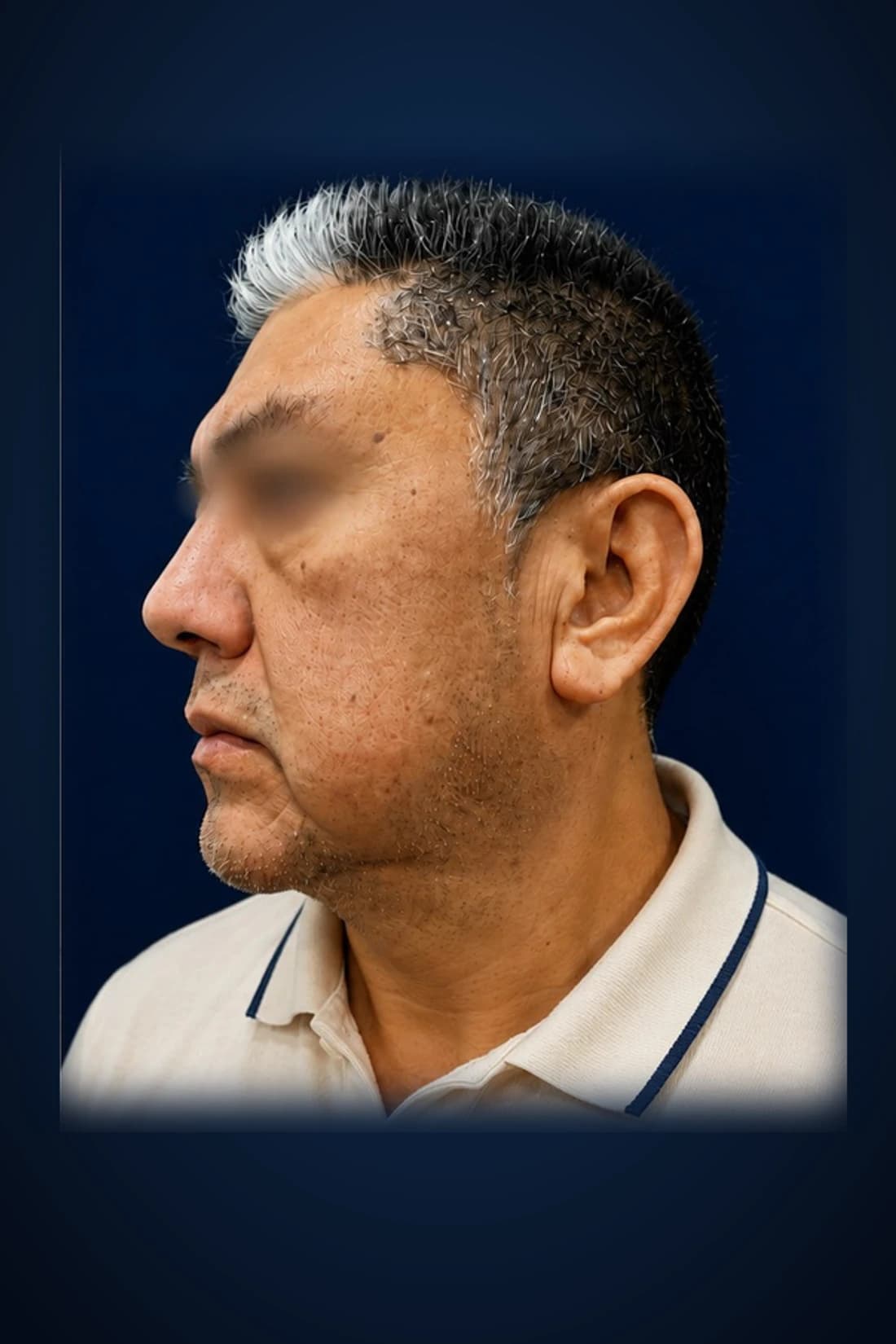 Face + neck rejuvenation · Profile, after-treatment profile patient photograph demonstrating documented jaw-to-neck contour changes. Individual results vary.