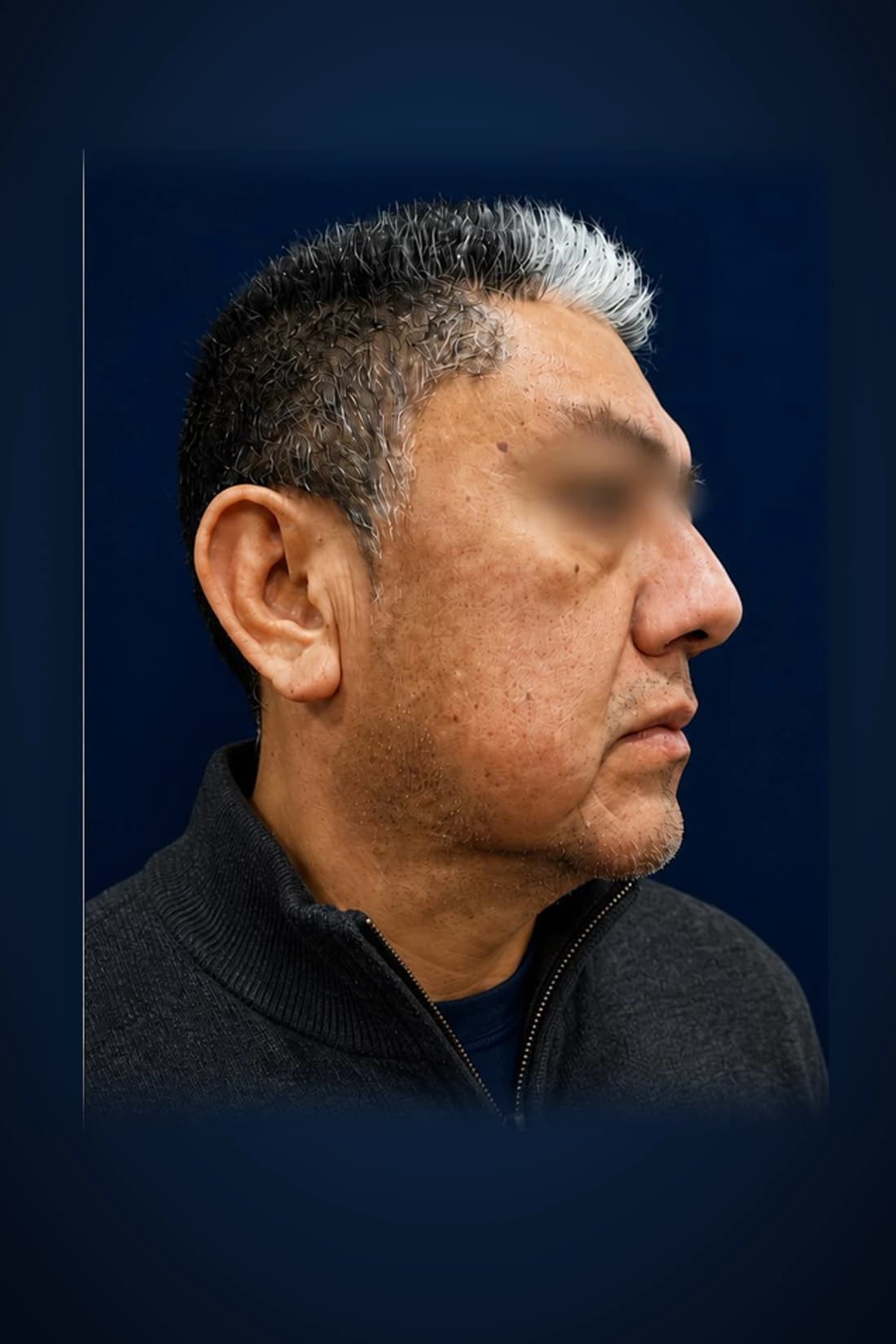 Before treatment photograph for Face + neck rejuvenation · Profile at Dagan MD in New York City. Individual results vary.