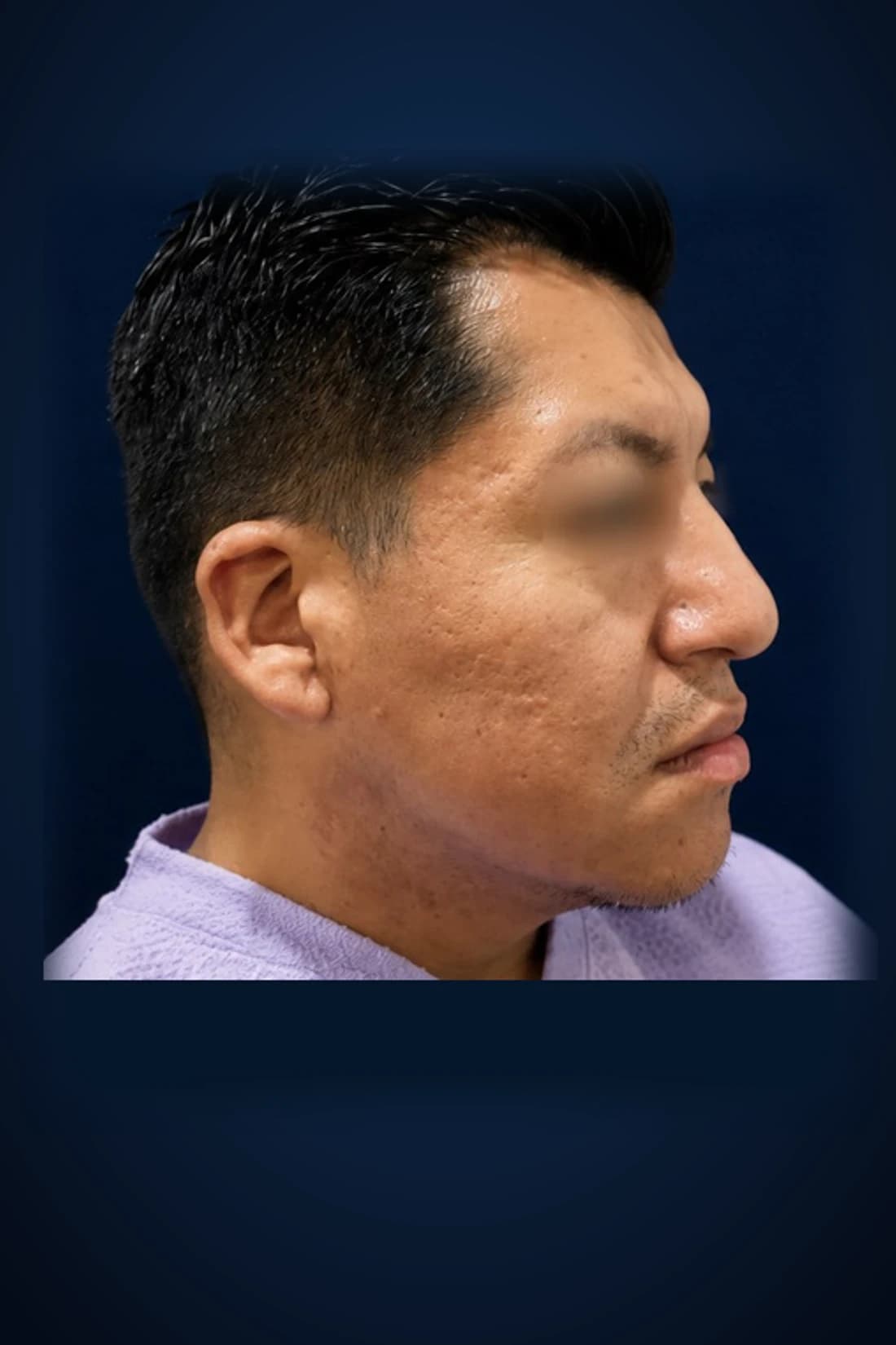 Procedure classification pending, before-treatment profile patient photograph. Individual results vary.