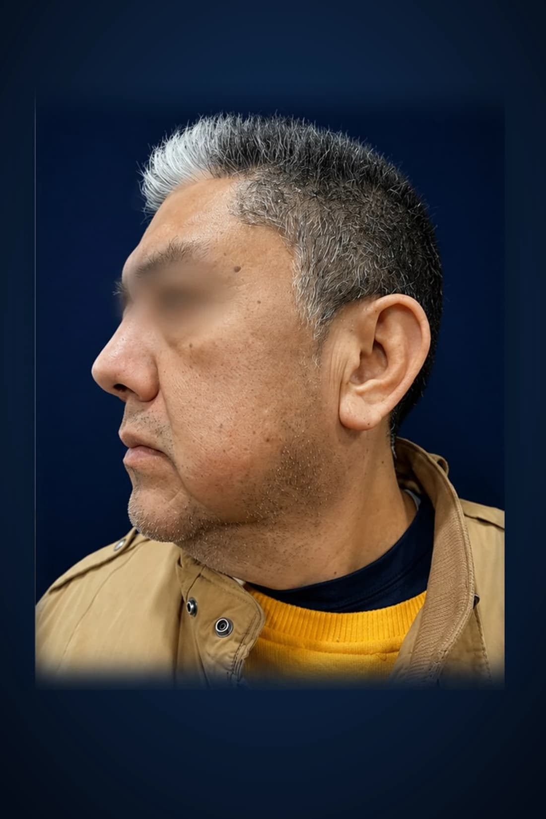 After treatment photograph for Procedure classification pending at Dagan MD in New York City. Individual results vary.