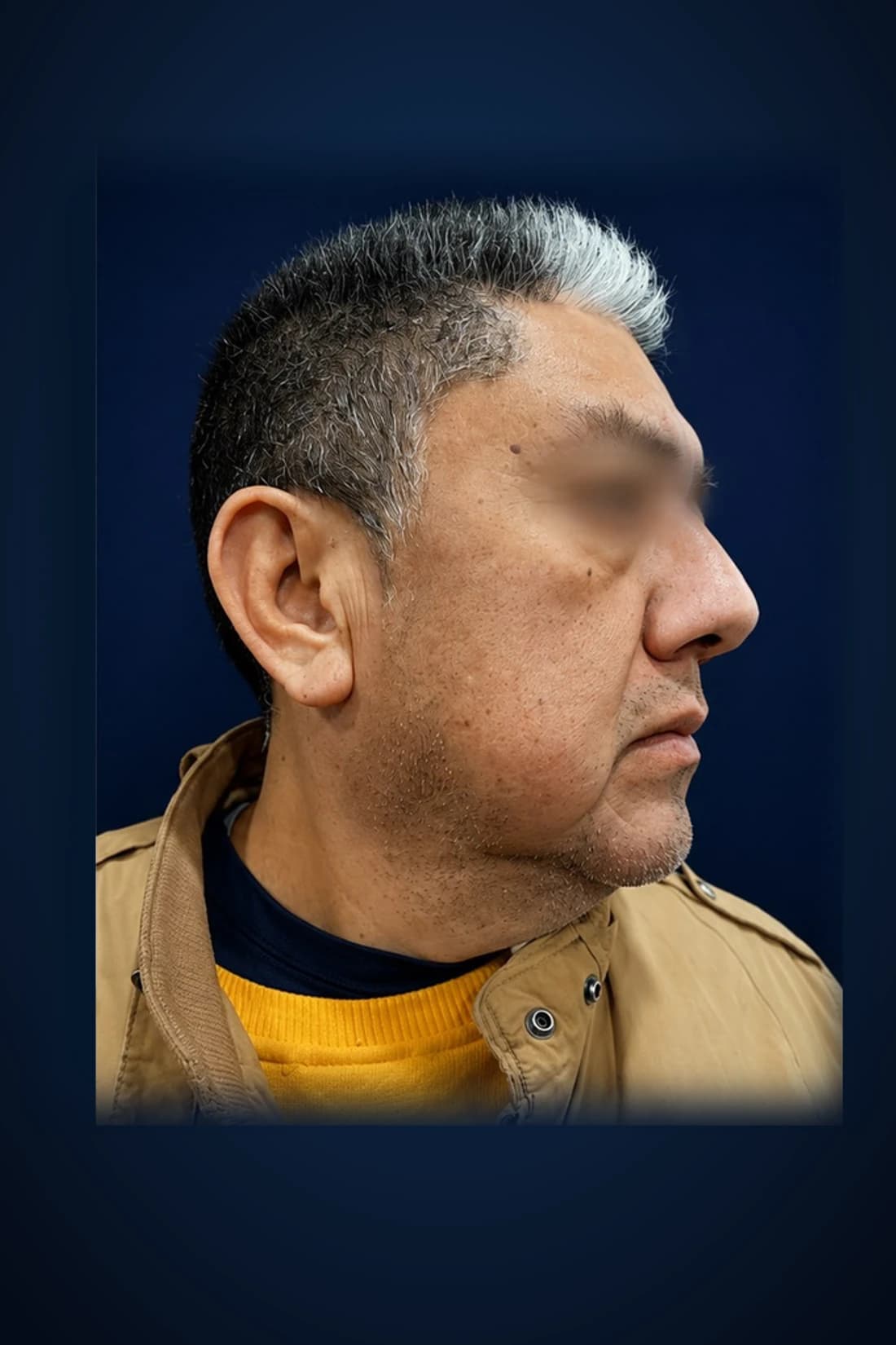 Before treatment photograph for Procedure classification pending at Dagan MD in New York City. Individual results vary.