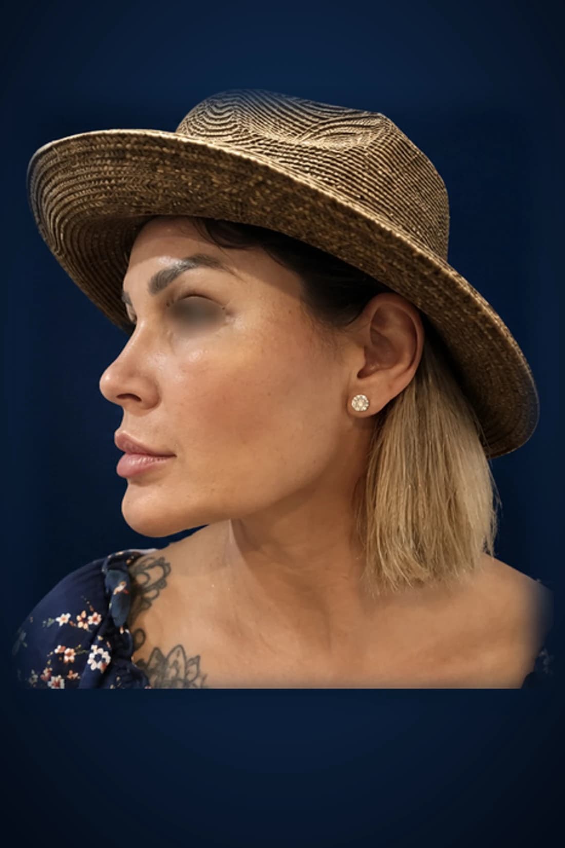 Rhinoplasty · Featured profile, after-treatment profile patient photograph demonstrating documented dorsal-contour and tip-position changes. Individual results vary.