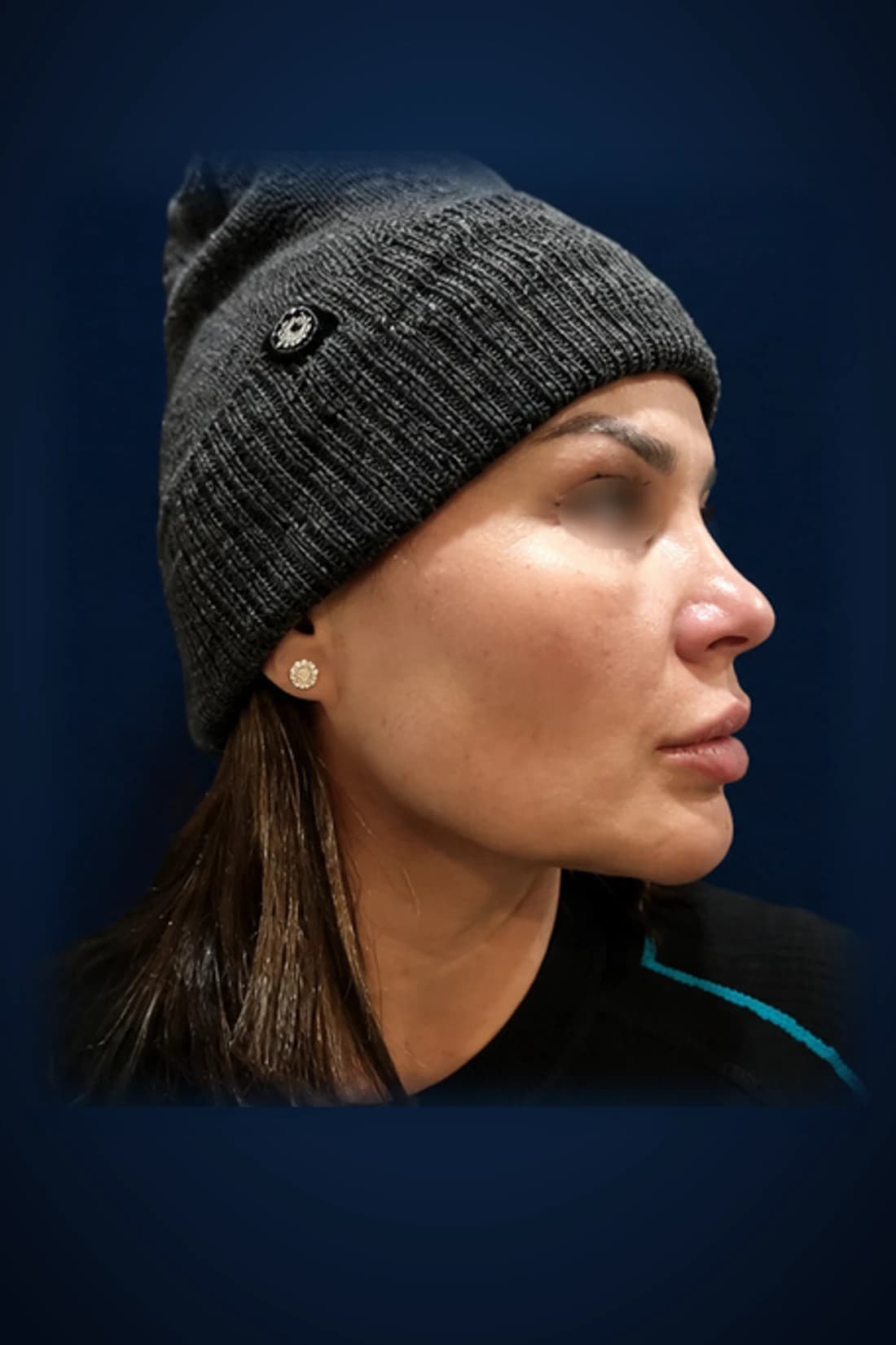 Before treatment photograph for Rhinoplasty · Featured profile at Dagan MD in New York City. Individual results vary.