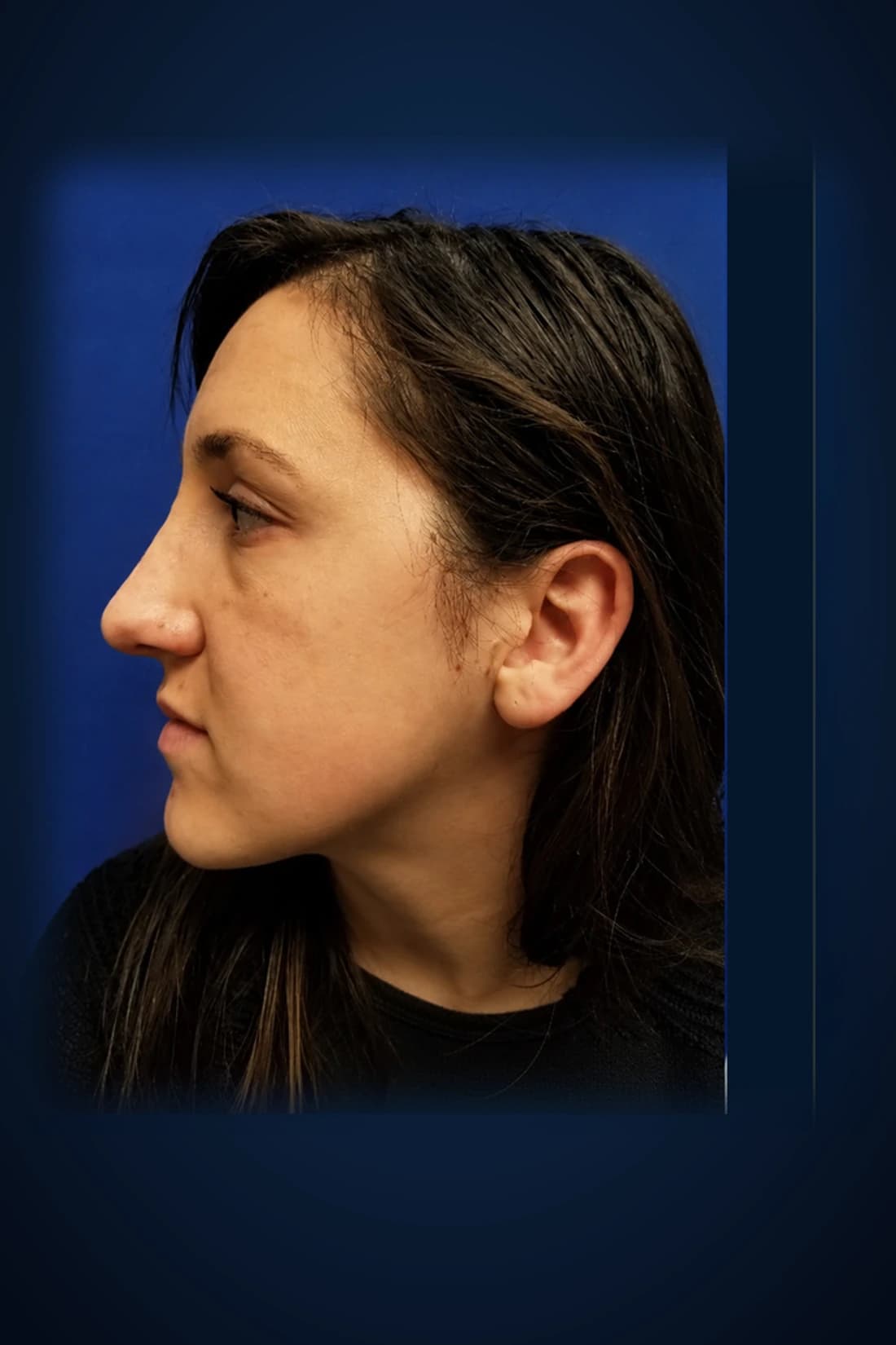 After treatment photograph for Rhinoplasty · Opposed profile at Dagan MD in New York City. Individual results vary.