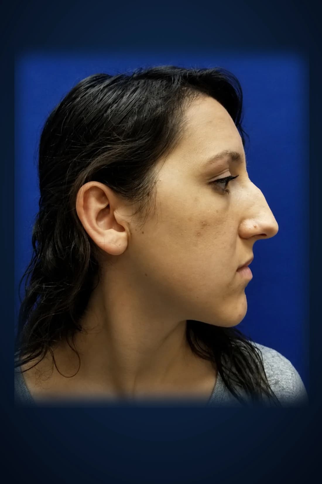 Before treatment photograph for Rhinoplasty · Opposed profile at Dagan MD in New York City. Individual results vary.