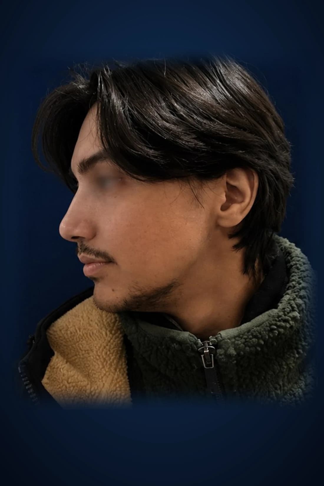 Rhinoplasty · Profile, after-treatment profile patient photograph demonstrating documented dorsal-contour and nasal-proportion changes. Individual results vary.