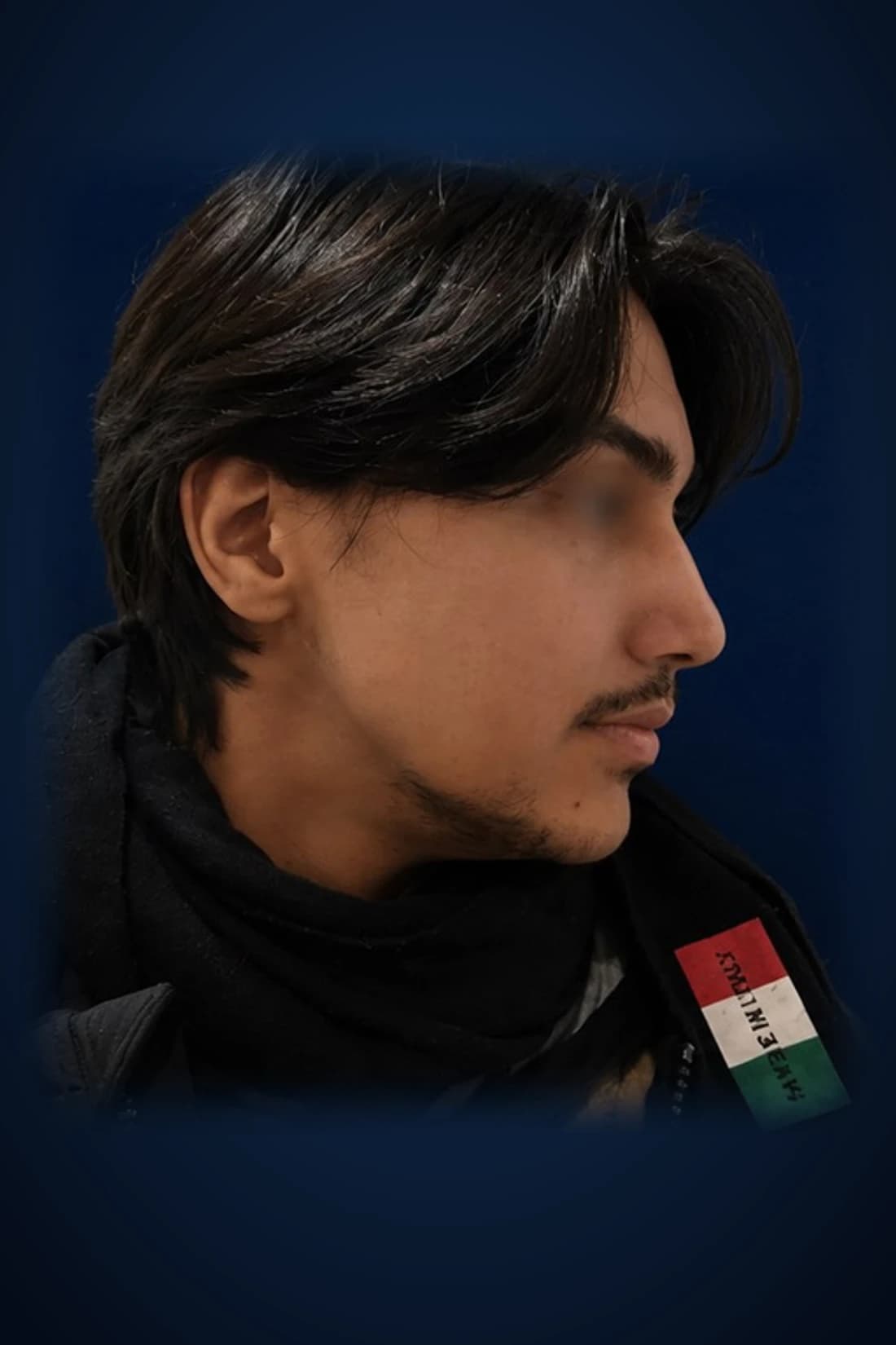Before treatment photograph for Rhinoplasty · Profile at Dagan MD in New York City. Individual results vary.