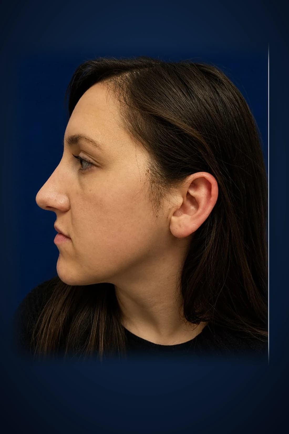 Rhinoplasty · Profile, after-treatment profile patient photograph demonstrating documented bridge-contour and tip-definition changes. Individual results vary.
