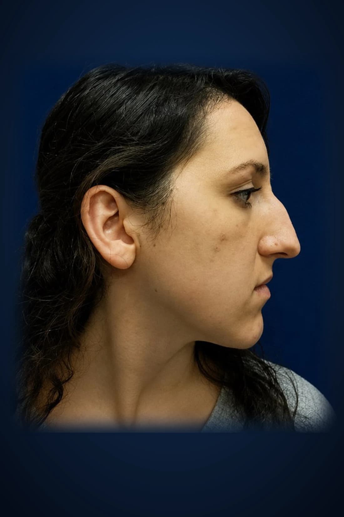 Before treatment photograph for Rhinoplasty · Profile at Dagan MD in New York City. Individual results vary.
