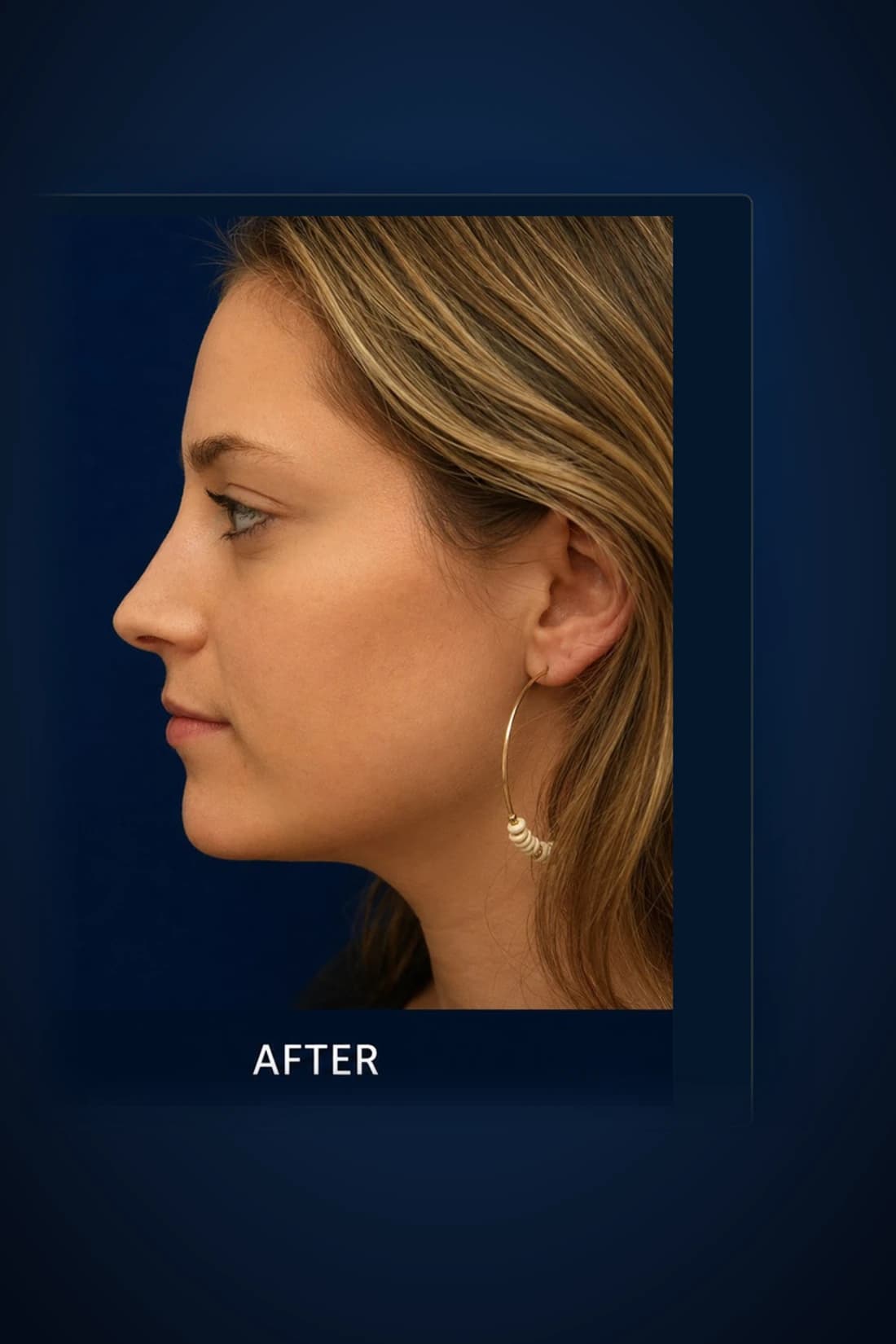 After treatment photograph for Rhinoplasty · Profile at Dagan MD in New York City. Individual results vary.
