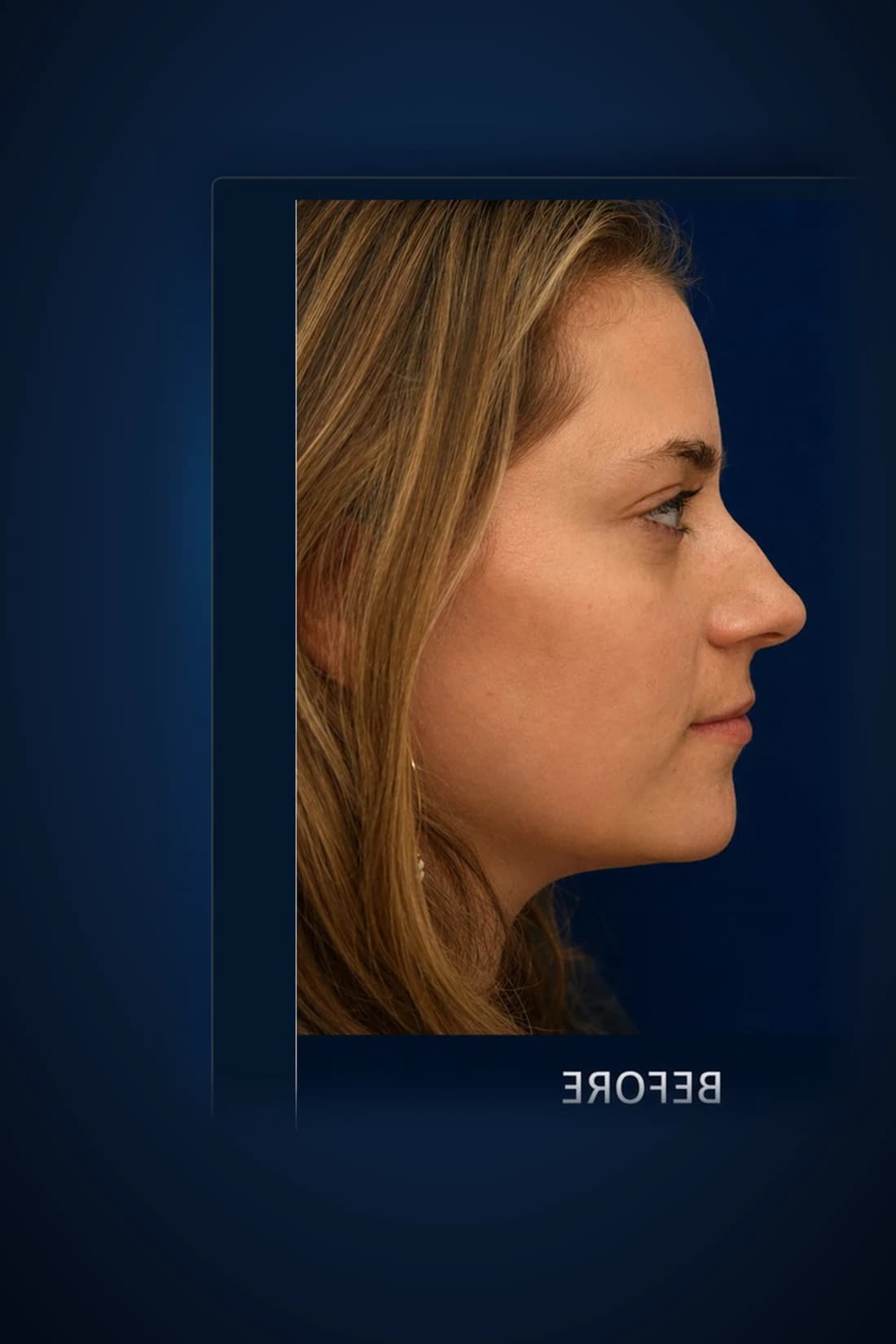 Rhinoplasty · Profile, before-treatment profile patient photograph. Individual results vary.