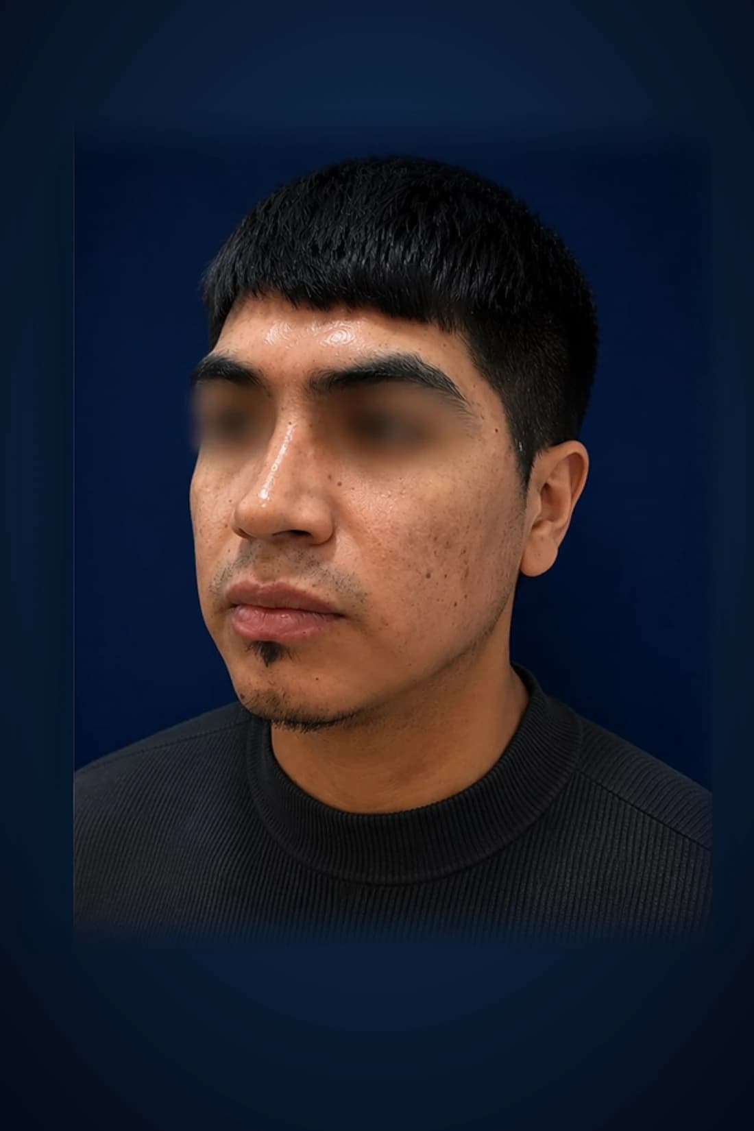After treatment photograph for Rhinoplasty · Three-quarter view at Dagan MD in New York City. Individual results vary.