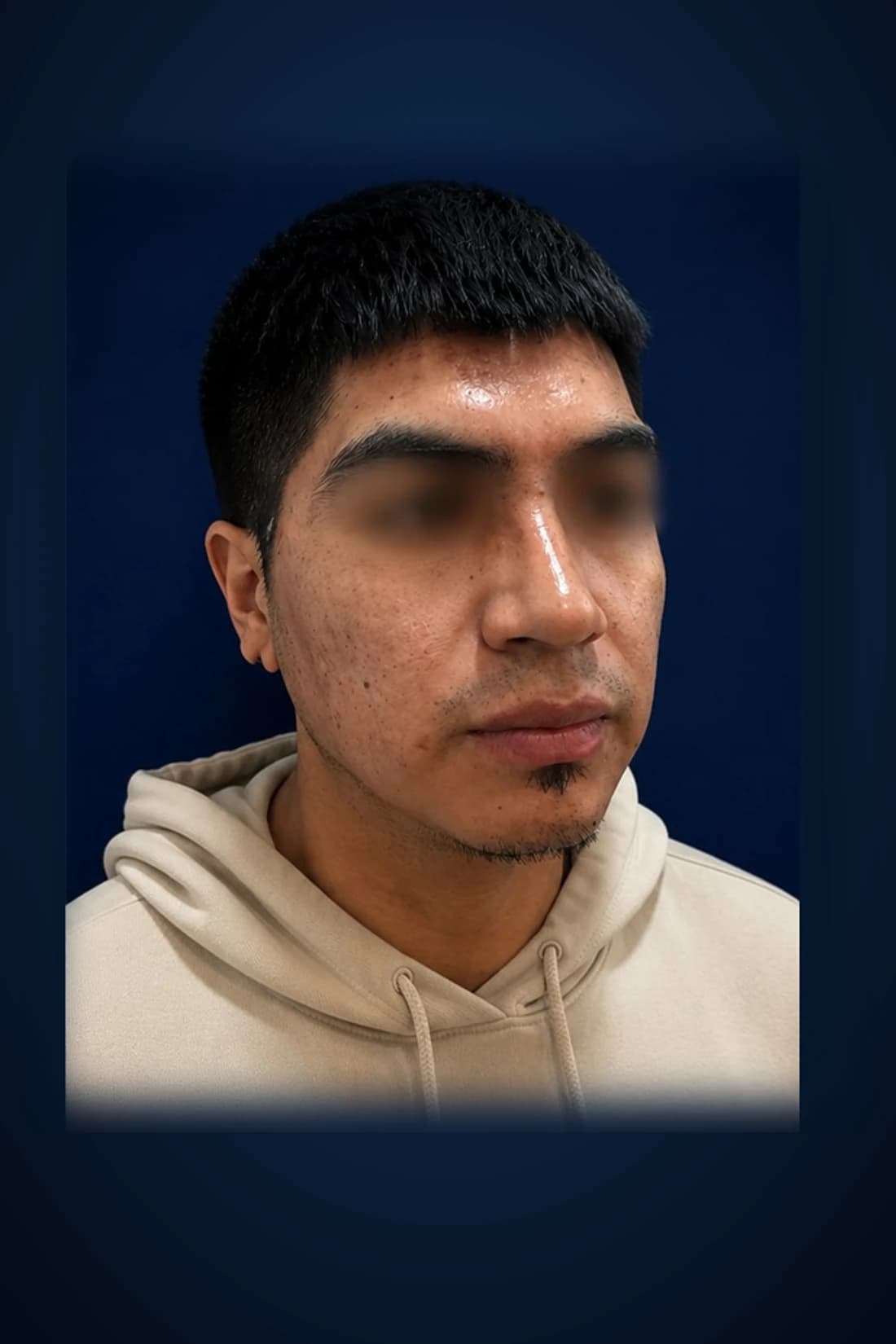 Before treatment photograph for Rhinoplasty · Three-quarter view at Dagan MD in New York City. Individual results vary.