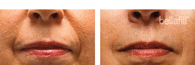 Bellafill® dermal filler before and after photo