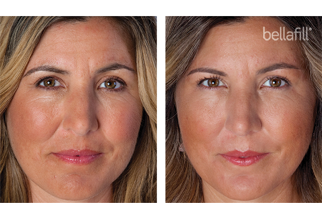 Bellafill® dermal filler before and after photo