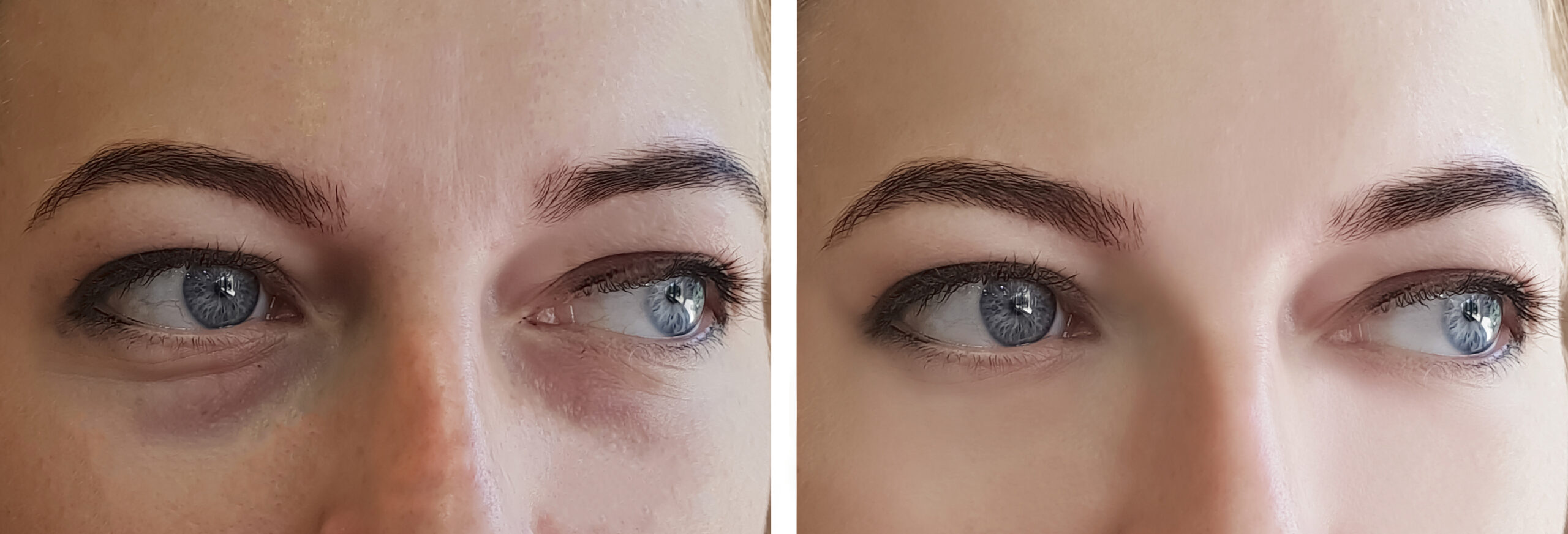 blepharoplasty before and after