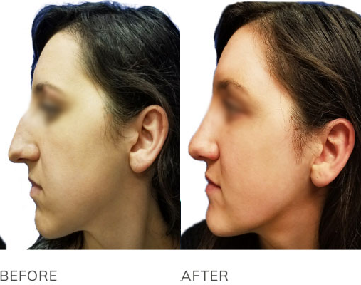 Rhinoplasty (Nose Job) before and after