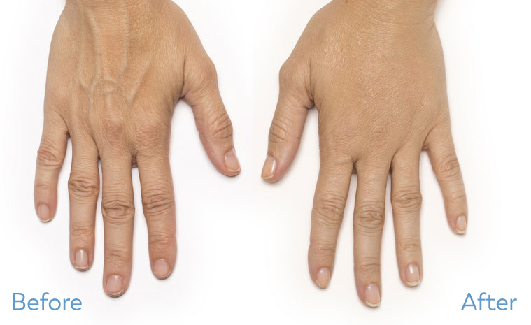 Radiesse® For Hands before and after
