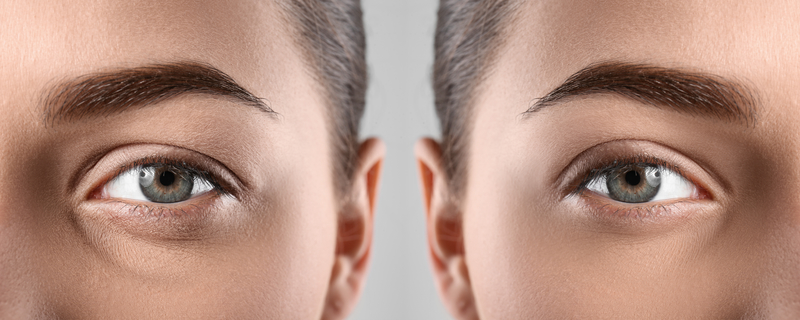 Woman before and after blepharoplasty procedure, closeup. Cosmetic surgery