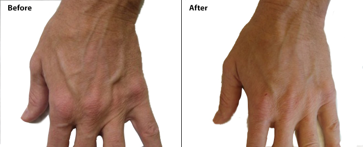 sculptra hand before after