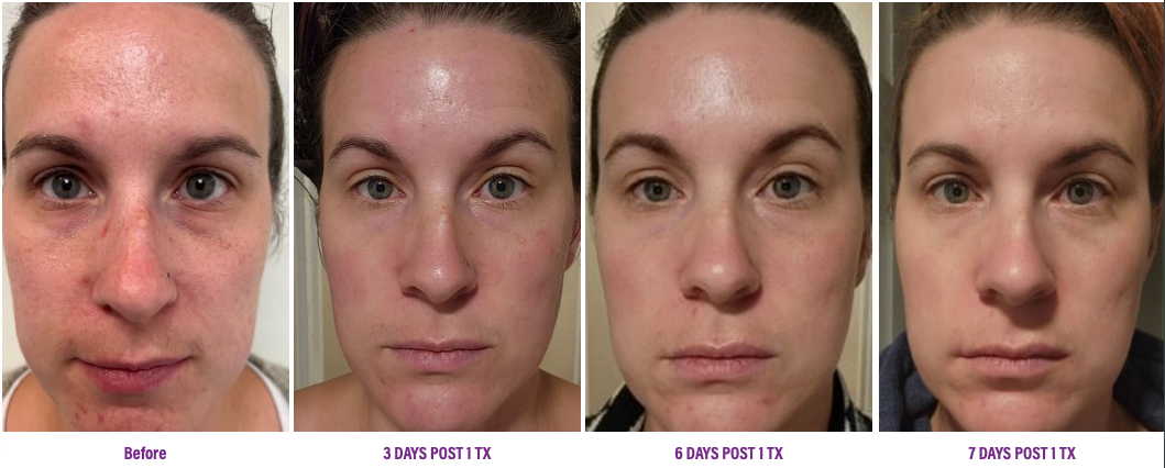 Full Face Resurfacing and Acne Scar Healing Progression Skin Type 2